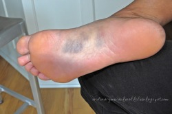 Painful Heel